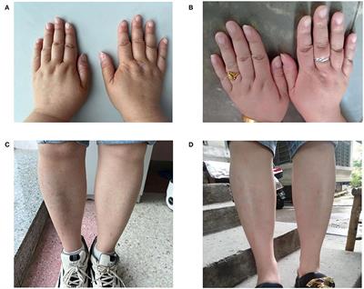 Deanxit and tandospirone relieved unexplained limb edema in a depressed pituitary adenoma survivor: A case report